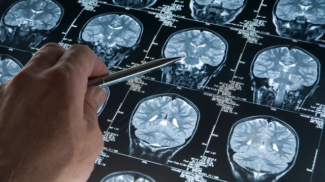 A close-up of a hand pointing at MRI scans of the human brain. 